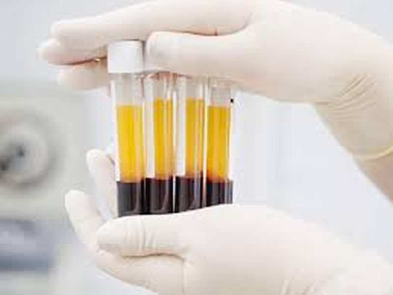 Plasma Rico en Fibrina (PRF)