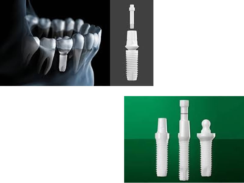 Implantes biocompatibles 100% Zirconio